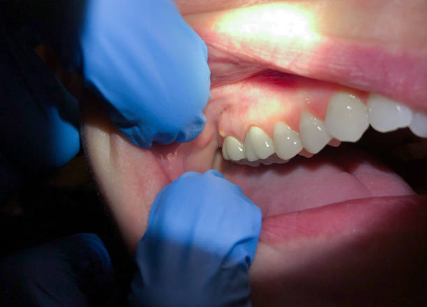 Best Emergency Dentist for Lost Fillings or Crowns in Rural Retreat, VA